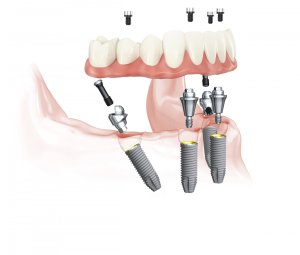 the All-on-4® treatment concept