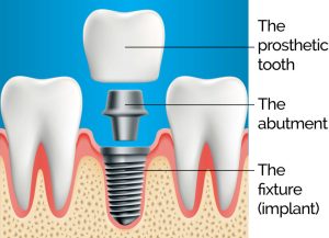 Components of a Dental Implant